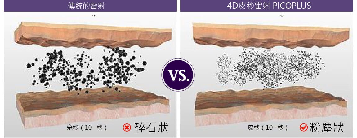 4D皮秒雷射優勢